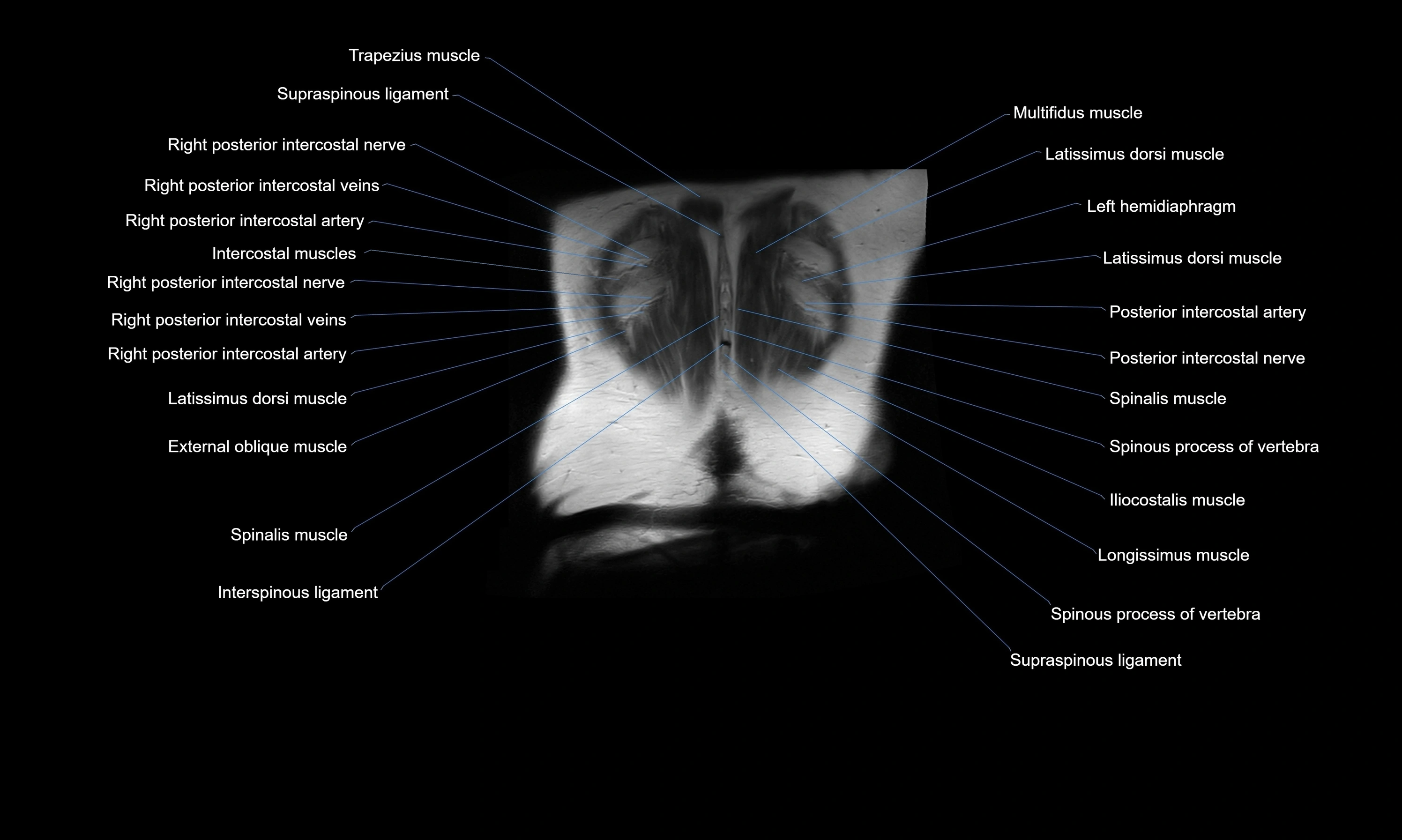 MRI Abdomen axial cross sectional anatomy radiology  image-img-00001-00055.webp